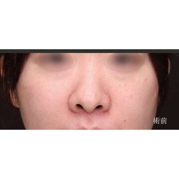 聖心美容クリニックの鼻の症例写真[ビフォー]