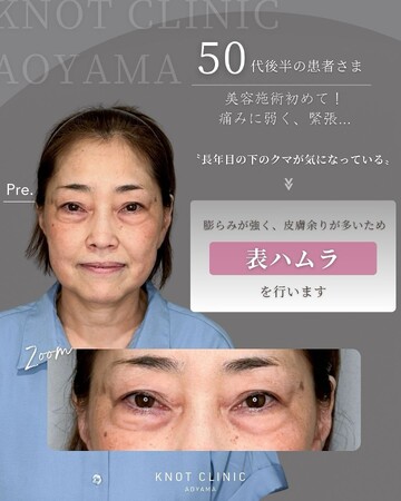 KNOT CLINIC AOYAMAの目元・クマ・眉下・涙袋整形の症例写真