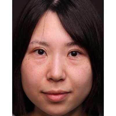 涙袋を際立たせる裏ハムラ法で目の下のクマを改善の症例写真[ビフォー]