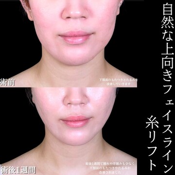 アリエル美容クリニック 大宮院のしわ・たるみ整形(注入、糸、フェイスリフト)の症例写真