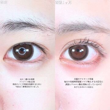 アリエル美容クリニック 大宮院の二重の症例写真