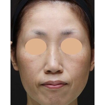 聖心美容クリニックのリフトアップの症例写真[ビフォー]