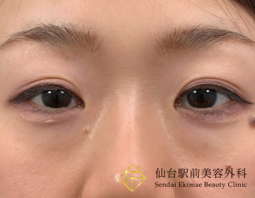 仙台駅前美容外科の目元・クマ・眉下・涙袋整形の症例写真[ビフォー]