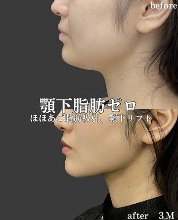 Plume Clinicの脂肪吸引の症例写真