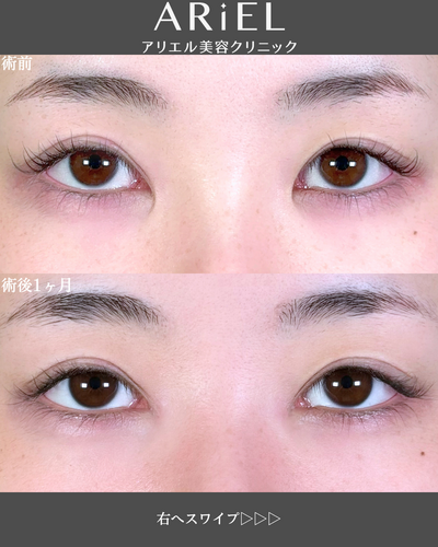 目頭切開の症例写真