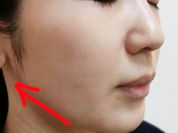 やさしい美容皮膚科・皮フ科 秋葉原院/シミレーザー東京の輪郭・顎・エラ・額・小顔整形の症例写真[ビフォー]