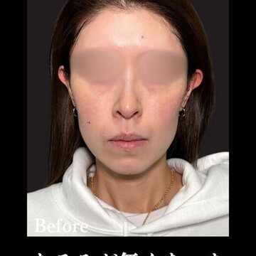 PRISM Beauty Clinicのリフトアップの症例写真[ビフォー]