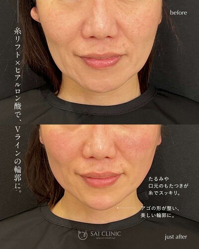 糸リフト 8本とヒアルロン酸（アゴ）1ccの症例写真