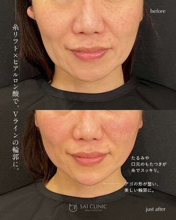 SAI CLINIC （サイクリニック）のリフトアップの症例写真
