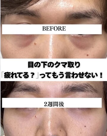 くみこクリニック 四条烏丸院の目元・クマ・眉下・涙袋整形の症例写真