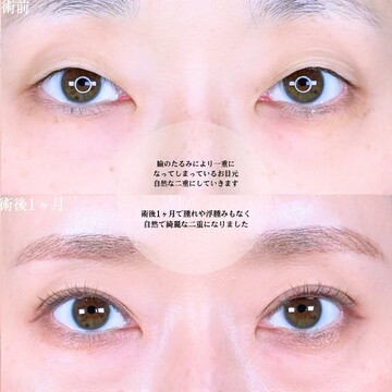 アリエル美容クリニック 大宮院の二重の症例写真