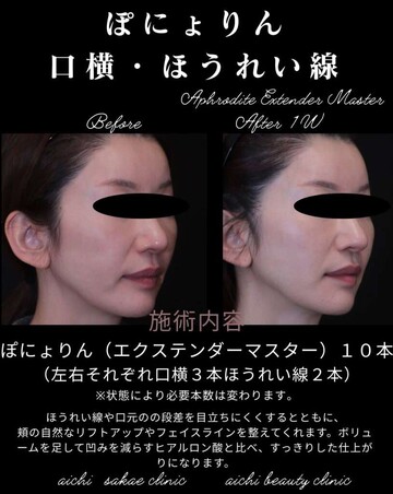 あいちビューティークリニック栄本院のリフトアップの症例写真