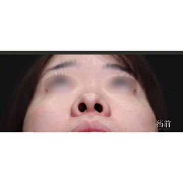 聖心美容クリニックの鼻の症例写真[ビフォー]