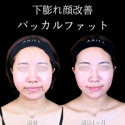 バッカルファット/エラボトックスの症例写真