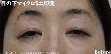 静岡美容外科橋本クリニックの目元・クマ・眉下・涙袋整形の症例写真[ビフォー]