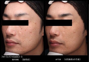 とりい皮膚科クリニックのシミ取り・肝斑・毛穴治療の症例写真