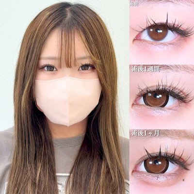 アリエルクイックループダブル二重埋没法の症例写真