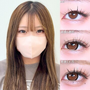 アリエル美容クリニック 大宮院の二重の症例写真