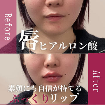 ギャラリークリニック銀座のしわ・たるみ整形(注入、糸、フェイスリフト)の症例写真