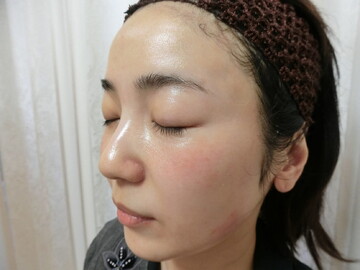 やさしい美容皮膚科・皮フ科 秋葉原院/シミレーザー東京の症例写真[アフター]