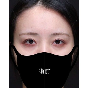 聖心美容クリニックの二重の症例写真[ビフォー]
