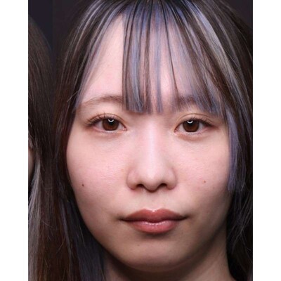 裏ハムラ法で目元のふくらみと影を改善（術後3ヶ月）の症例写真[アフター]