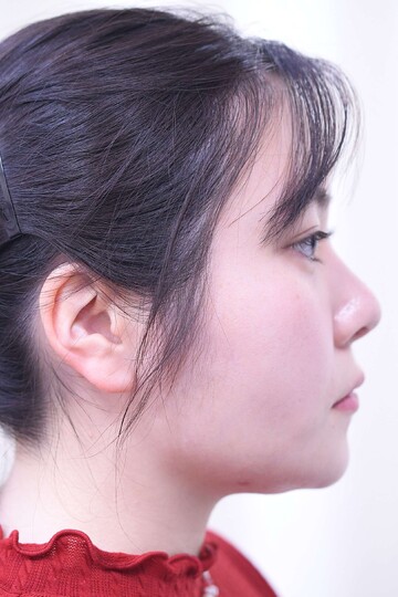 医療法人秀晄会 心斎橋コムロ美容外科クリニックの症例写真[アフター]
