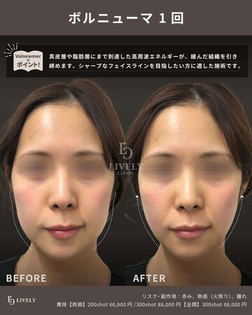 LIVELY CLINIC 浜松町院のしわ・たるみ整形(注入、糸、フェイスリフト)の症例写真