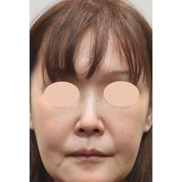 聖心美容クリニックのリフトアップの症例写真[ビフォー]