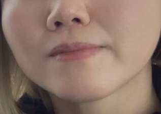 ペルラクリニック神宮前のリフトアップの症例写真[ビフォー]
