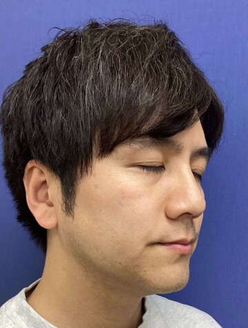 フェミークリニックの症例写真[アフター]
