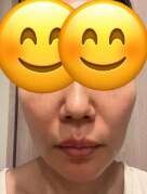 ペルラクリニック神宮前のリフトアップの症例写真[ビフォー]
