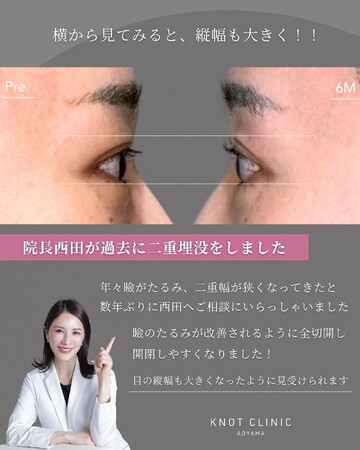 KNOT CLINIC AOYAMAの二重の症例写真