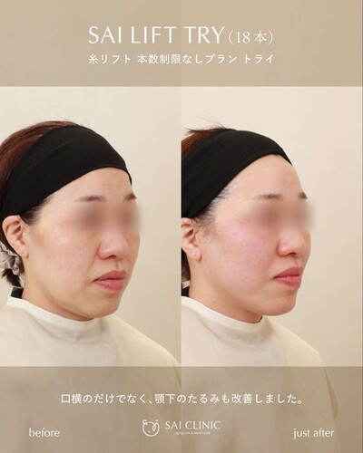 糸リフト（SAI LIFT TRY）18本の症例写真