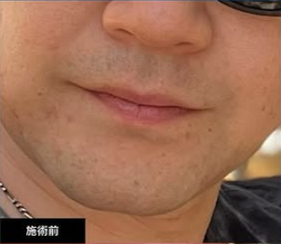 金山美容クリニックの医療脱毛の症例写真[ビフォー]