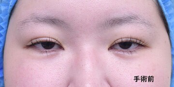医療法人秀晄会 心斎橋コムロ美容外科クリニックの目・二重整形の症例写真[ビフォー]