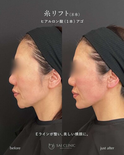 糸リフト 8本とヒアルロン酸（アゴ）1ccの症例写真