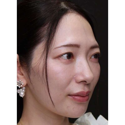 脂肪を活かす裏ハムラ法で段差のある目元を改善の症例写真[アフター]