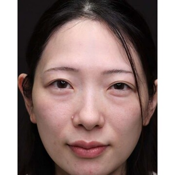聖心美容クリニックの目元の症例写真[ビフォー]