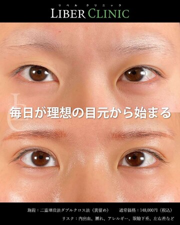 LIBER CLINIC （リベルクリニック）の目・二重整形の症例写真