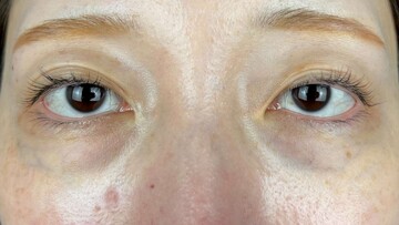 AI Beauty Clinicの目元・クマ・眉下・涙袋整形の症例写真[ビフォー]