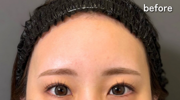 Plume Clinicの輪郭・顎・エラ・額・小顔整形の症例写真[ビフォー]