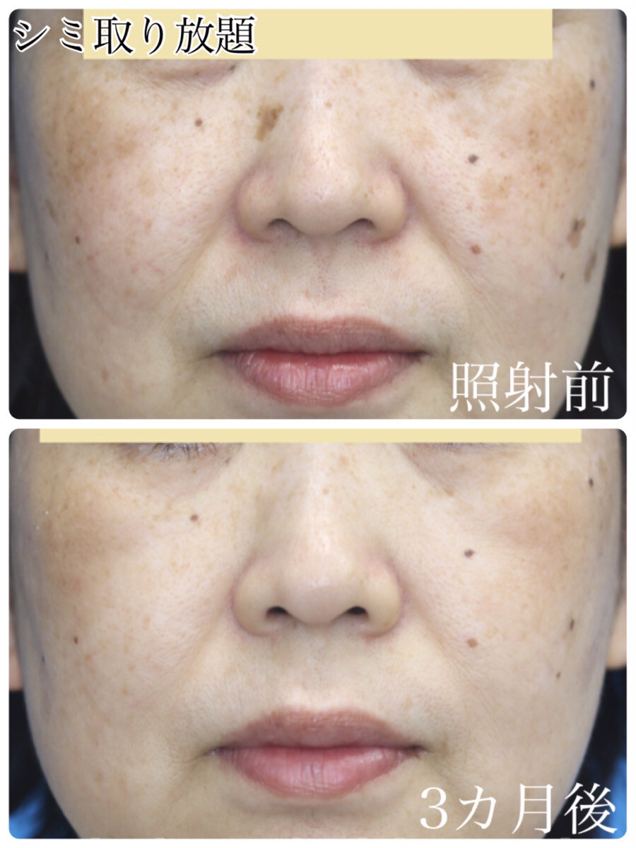 シミ取り放題 5分 施術前 3ケ月後 Qスイッチレーザー シミのレーザー治療の症例写真 画像 樹のひかり 形成外科 皮ふ科 Cs 美容医療の口コミ広場