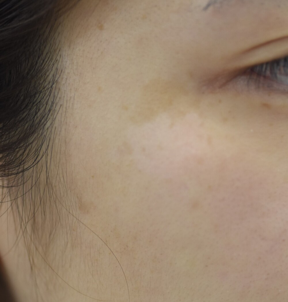 右こめかみの扁平母斑 ほくろ除去 あざ治療 イボ治療の症例写真 画像 みずほクリニック Cs 美容医療の口コミ広場