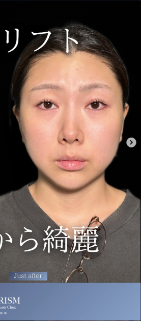 PRISM Beauty Clinicの症例写真[アフター]