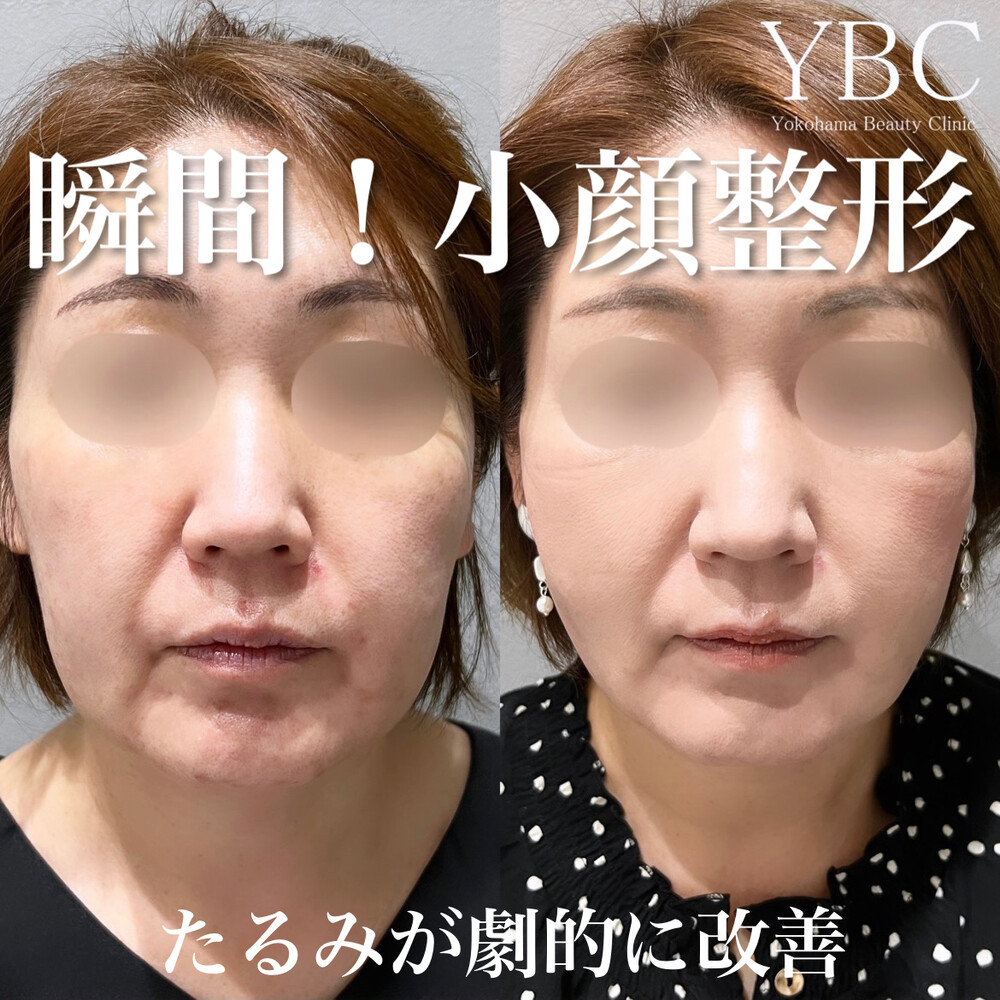 YBC式小顔リフト【院長による安心の小顔術】 (スプリング
