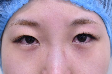 医療法人秀晄会 心斎橋コムロ美容外科クリニックの目・二重整形の症例写真[ビフォー]