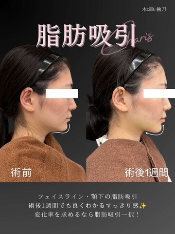 CHARIS BEAUTY CLINICの脂肪吸引の症例写真