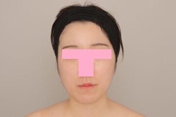 Mods Clinic (モッズクリニック)の脂肪吸引の症例写真[ビフォー]