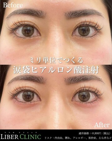 LIBER CLINIC （リベルクリニック）の目元・クマ・眉下・涙袋整形の症例写真